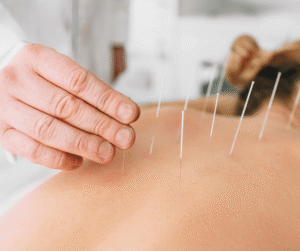 A practitioner's hand carefully placing thin acupuncture needles into a patient's back during a treatment session