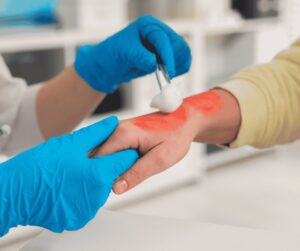A gloved healthcare provider treats a red burn on a patient's arm.