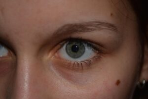 birthmark on face