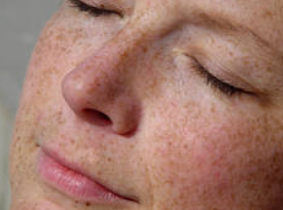 tanahoy.com freckles